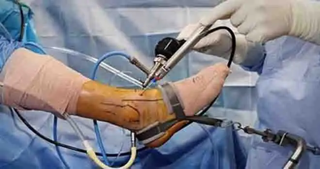 Achilles Tendon Debridement