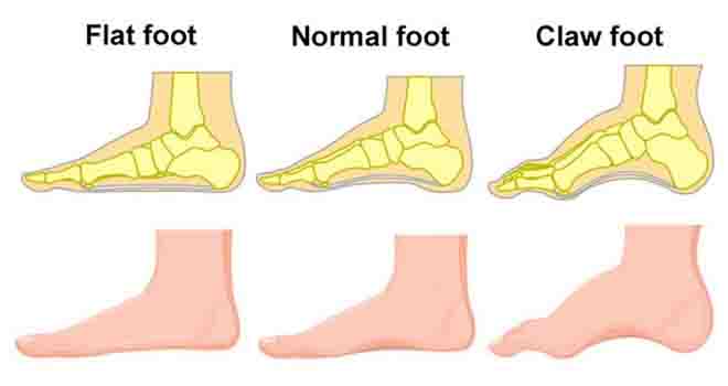 Cavus Foot