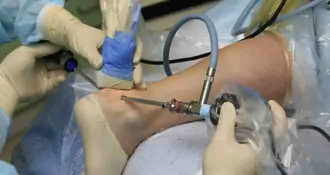 Ankle Arthroscopy