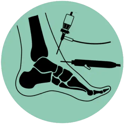 Ankle Arthroscopy