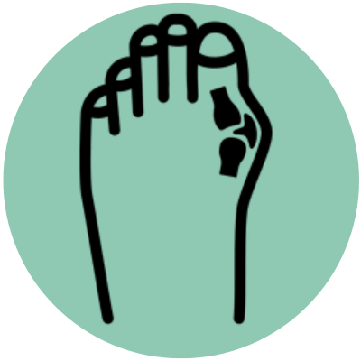 Bunion