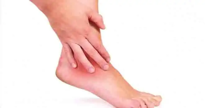 Ankle Osteochondral lesion