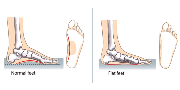 Flat Foot Treatment in Mumbai - Dr. Abhishek Kini